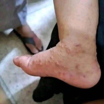 স্ক্যাবিস (Scabies): ছোঁয়াচে ত্বকের রোগ ও তার প্রতিকার