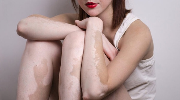 শ্বেতী রোগ