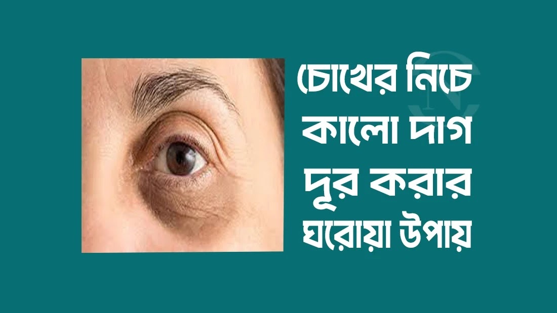 চোখের নিচে কালো দাগ
