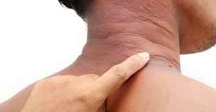 অ্যালার্জি